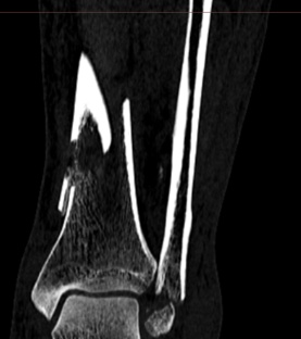 Caso clinico KIWI3D 1
