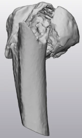 Caso clinico KIWI3D 10