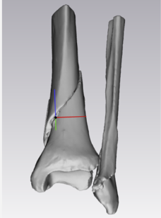 Caso clinico KIWI3D 2