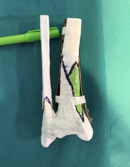 Caso clinico KIWI3D 3