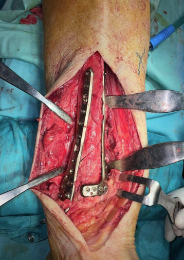 Caso clinico KIWI3D 5